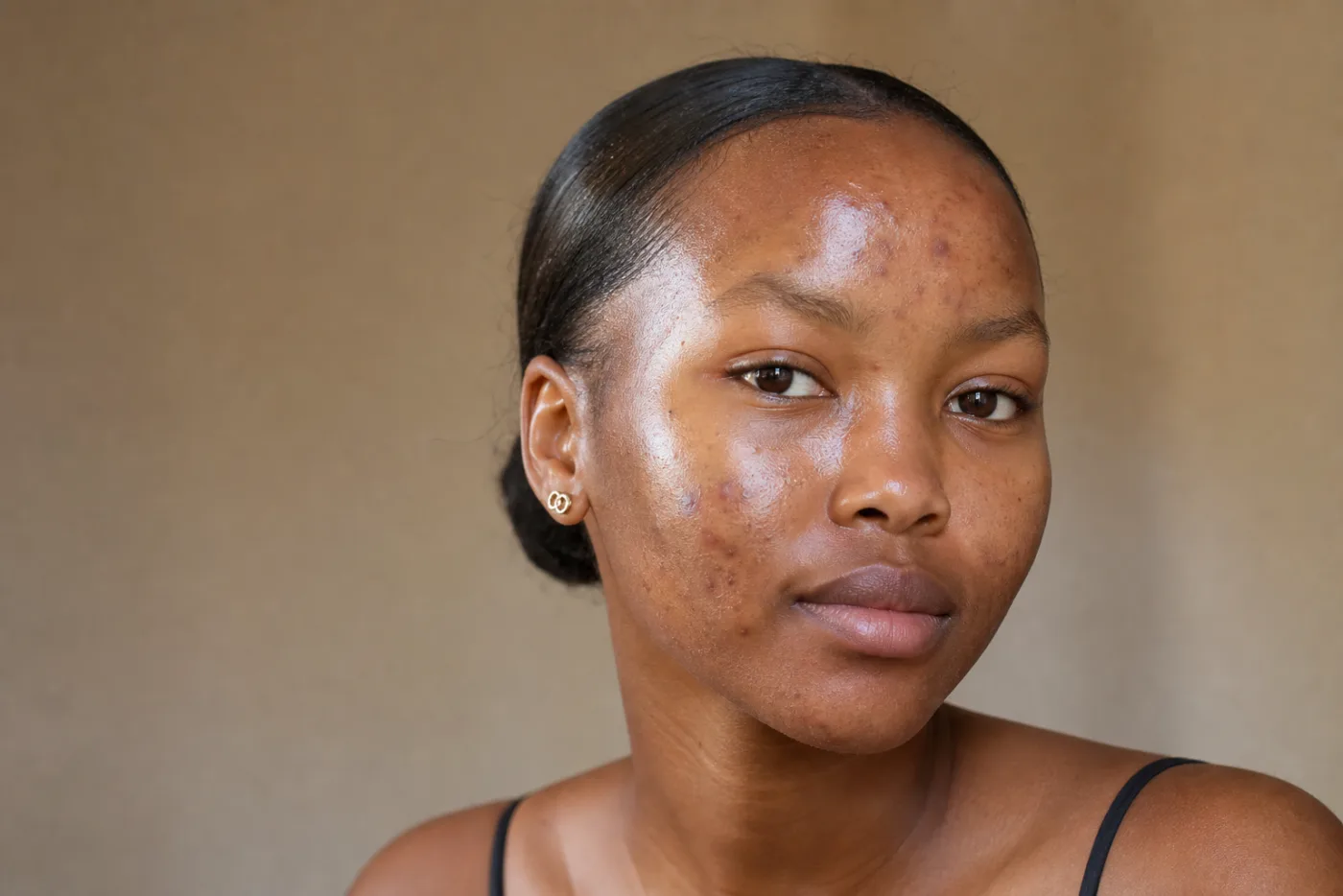 Acne & Oiliness